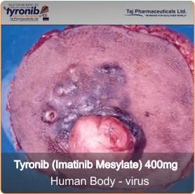 myelogenous leukaemia, acute lymphoblastic leukaemia and gastrointestinal tumours